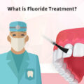 What is Fluoride treatment? 