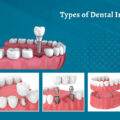 Types of Dental Implants