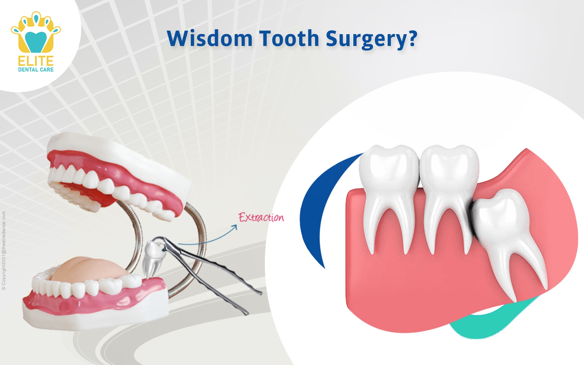 Is wisdom tooth removal a major surgery?