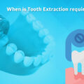 When is Tooth Extraction required?