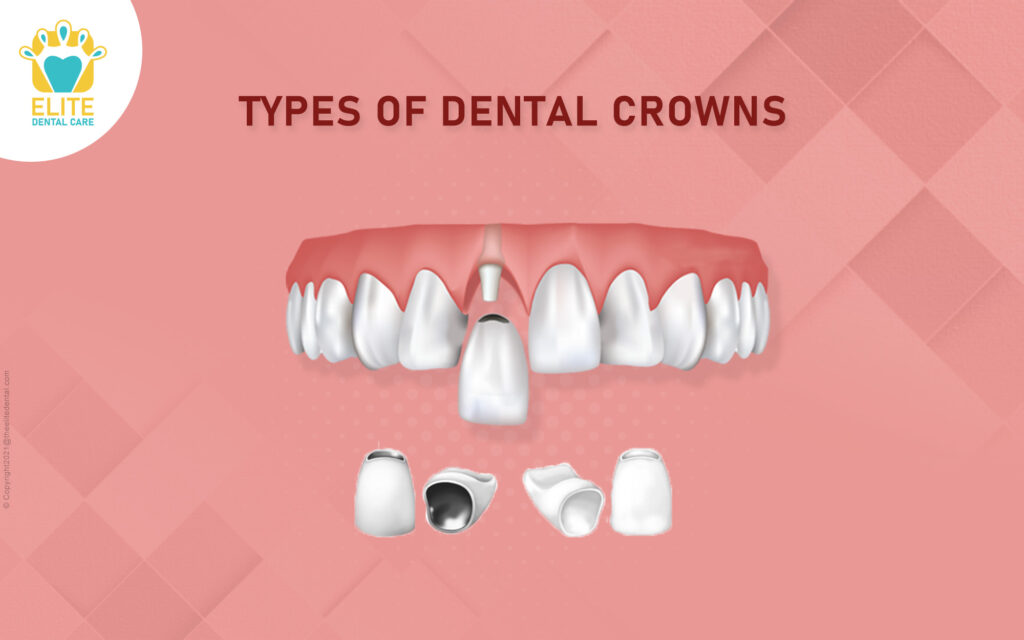 types-of-dental-crowns-elite-dental-care