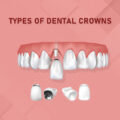 Types Of Dental Crowns