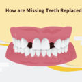How are missing teeth replaced?