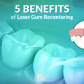 5 Benefits of Laser Gum Recontouring