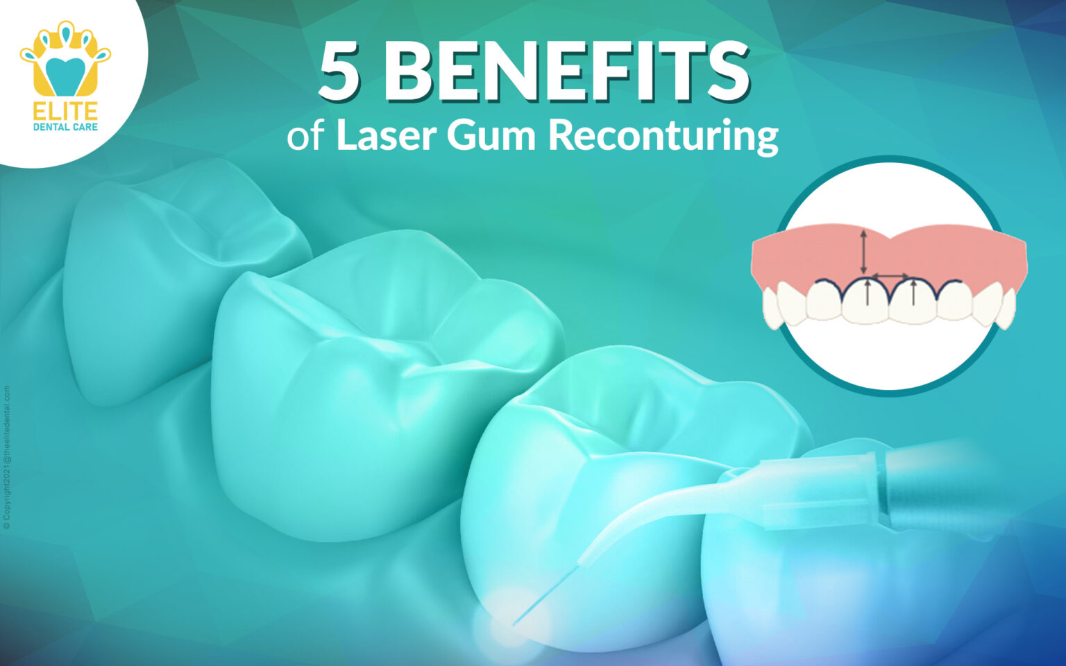 5 Benefits of Laser Gum Recontouring Elite Dental Care