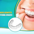 Clear Aligners’ Benefits Over Traditional Braces