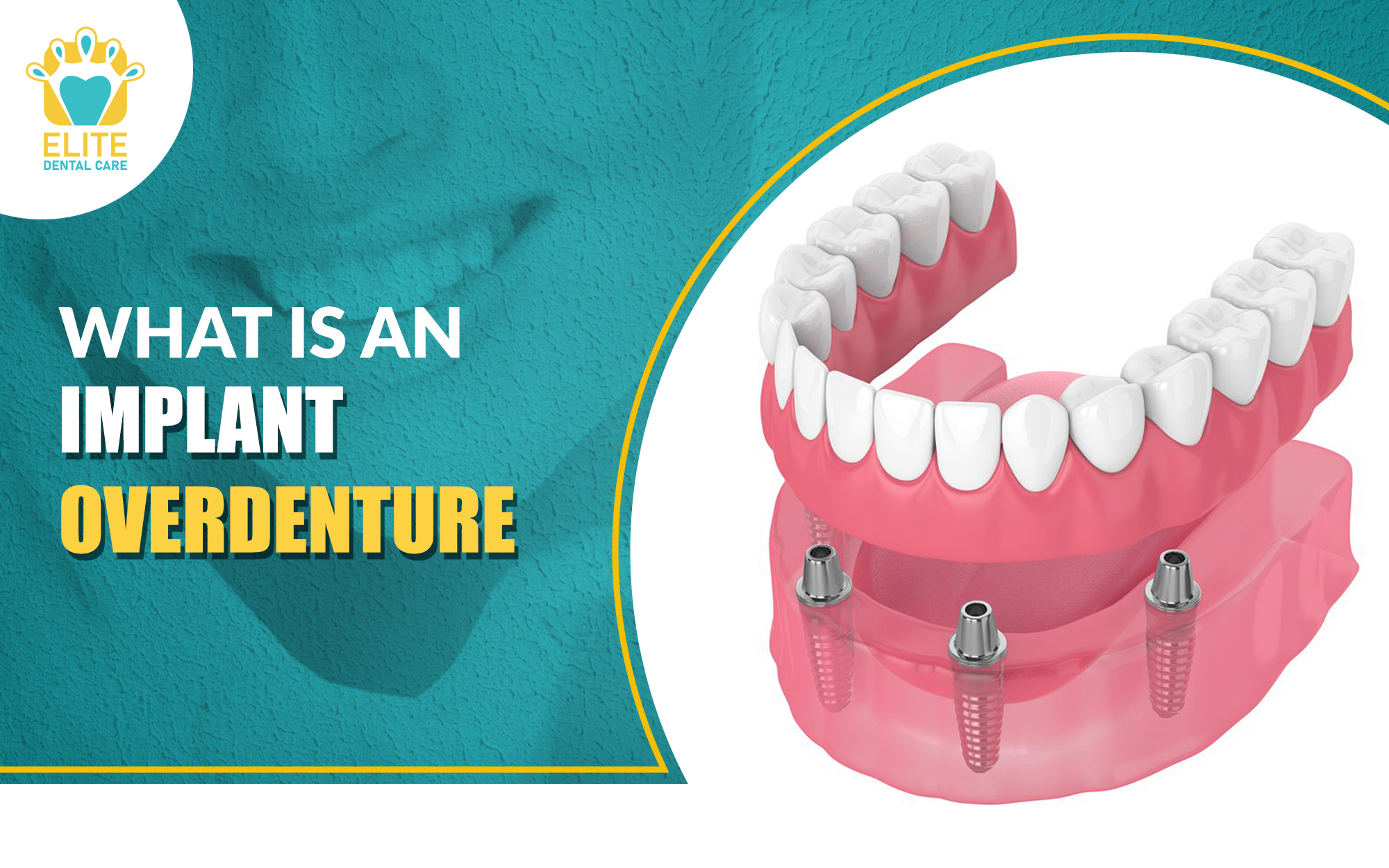 What is an Implant Overdenture?