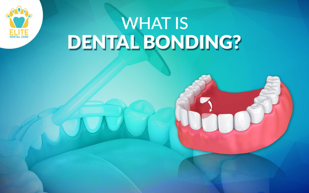 What is Dental Bonding? Elite Dental Care