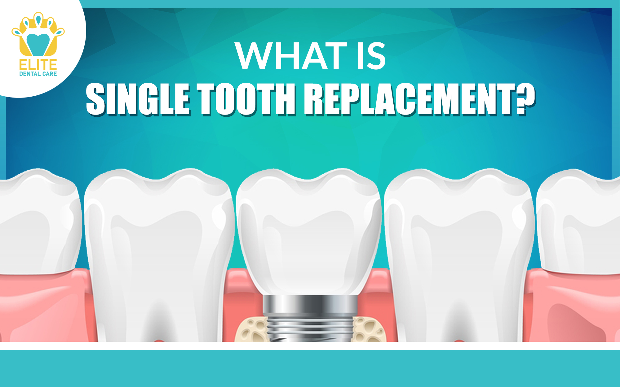 What is a single tooth replacement?