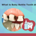 What is baby bottle tooth decay?