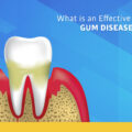 What is an Effective Cure for Gum Disease?