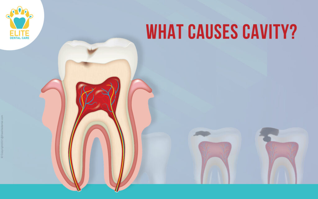 What Causes Cavity? Elite Dental Care