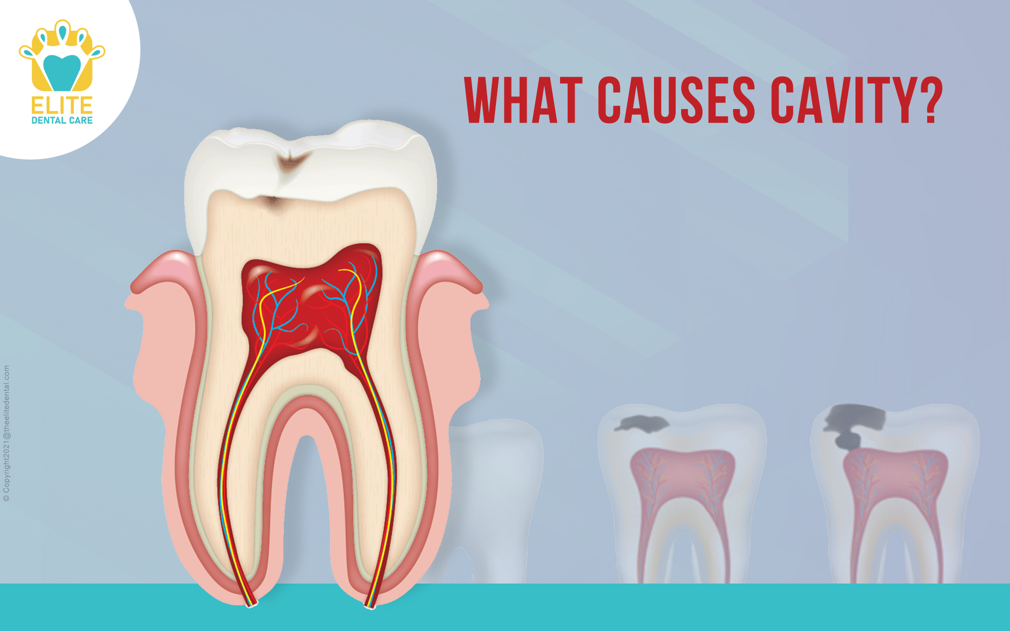 What Causes Cavity?