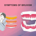 What are the Major Symptoms of Bruxism?