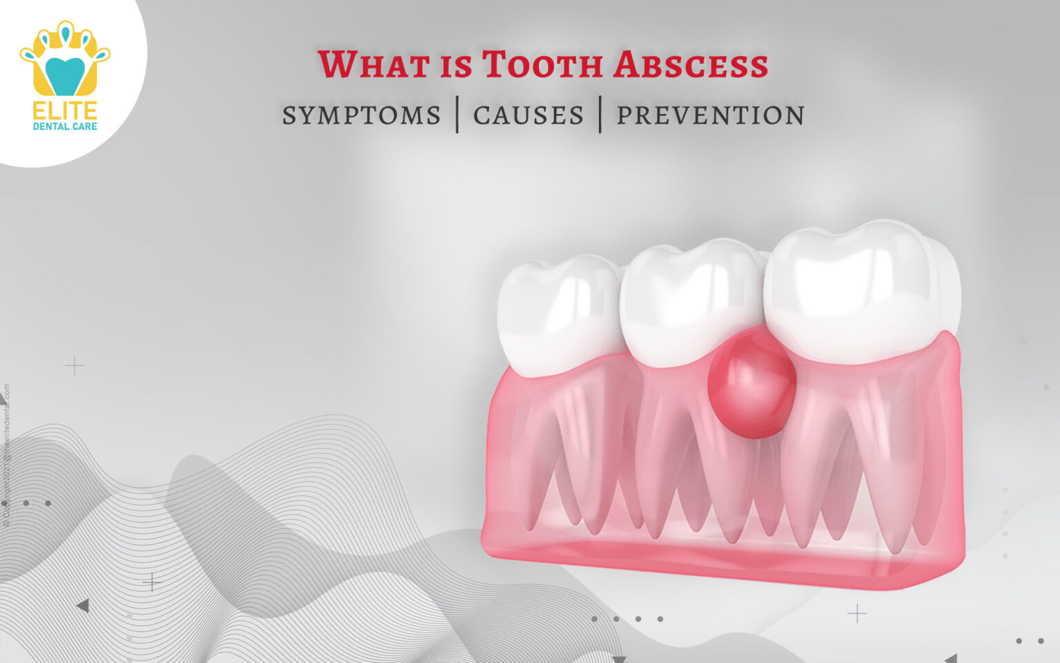 What are tooth abscess symptoms, causes, and prevention? Elite Dental