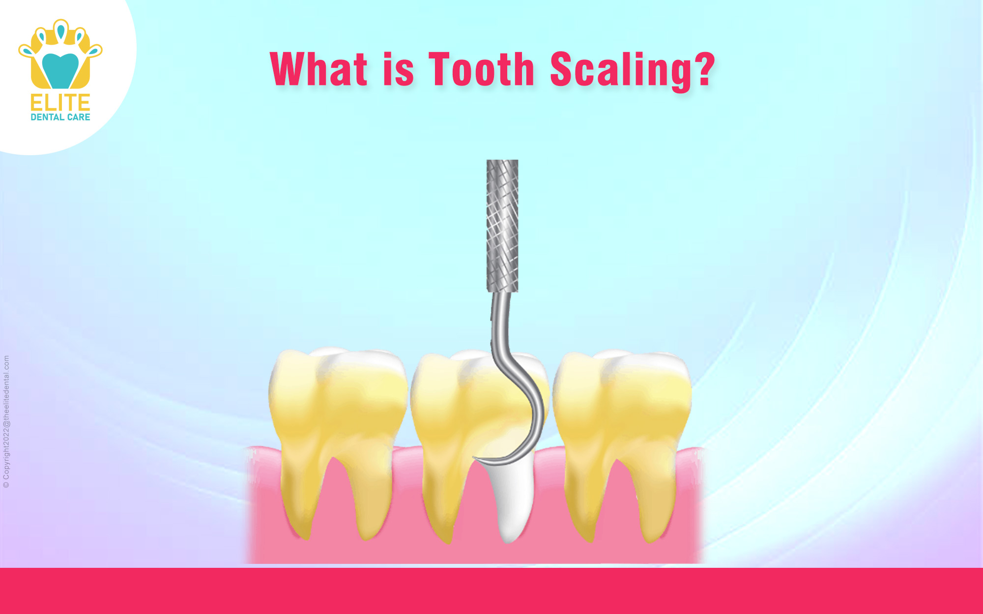 What is Tooth Scaling?