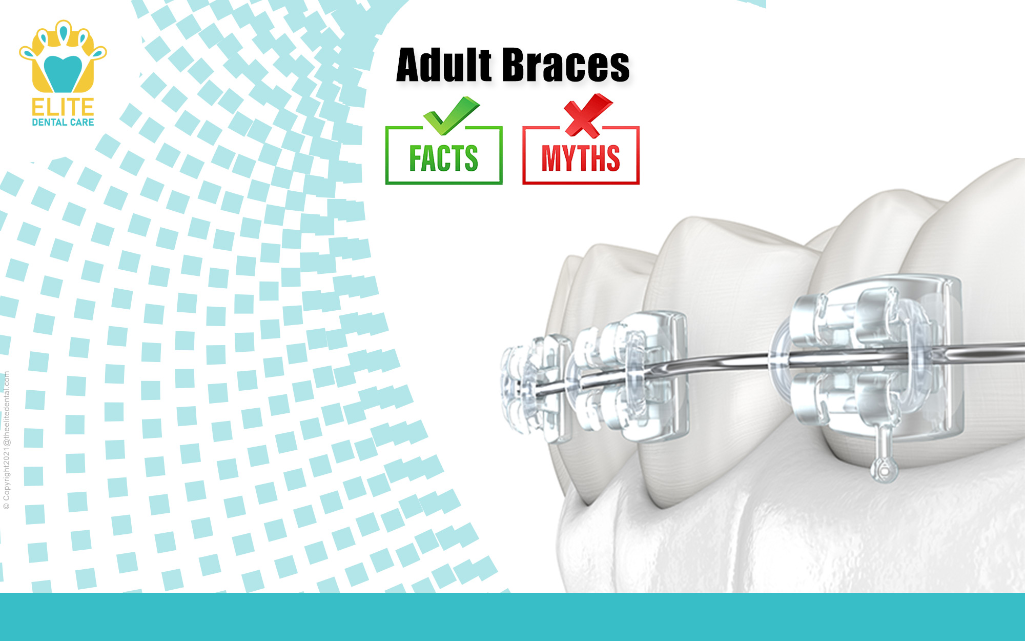 Adult Braces Myths and Facts