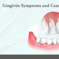 Gingivitis: Symptoms and Causes