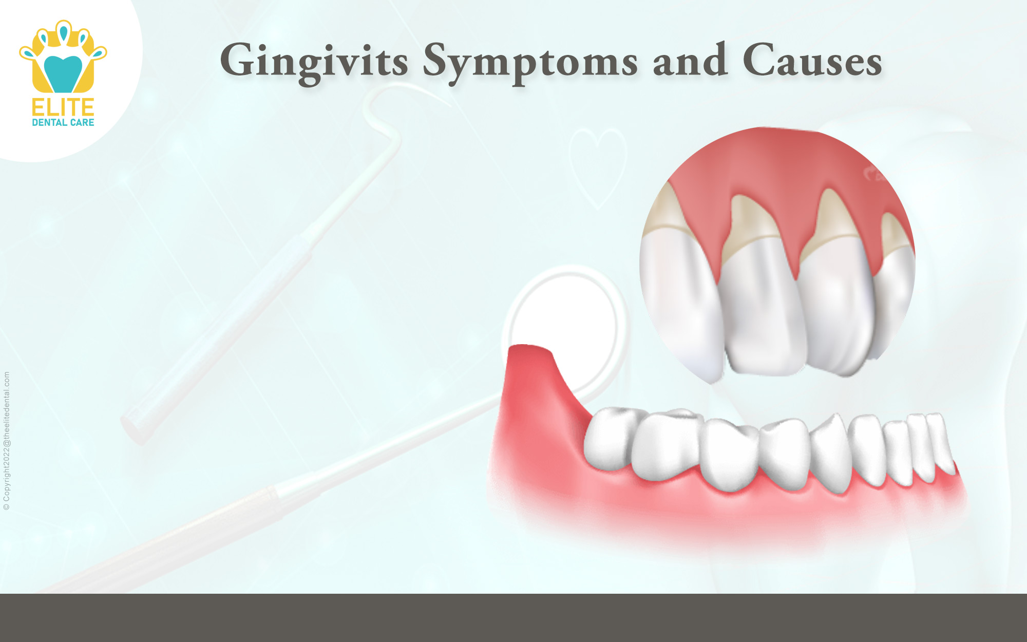 Gingivitis: Symptoms and Causes