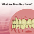 What are Receding Gums?