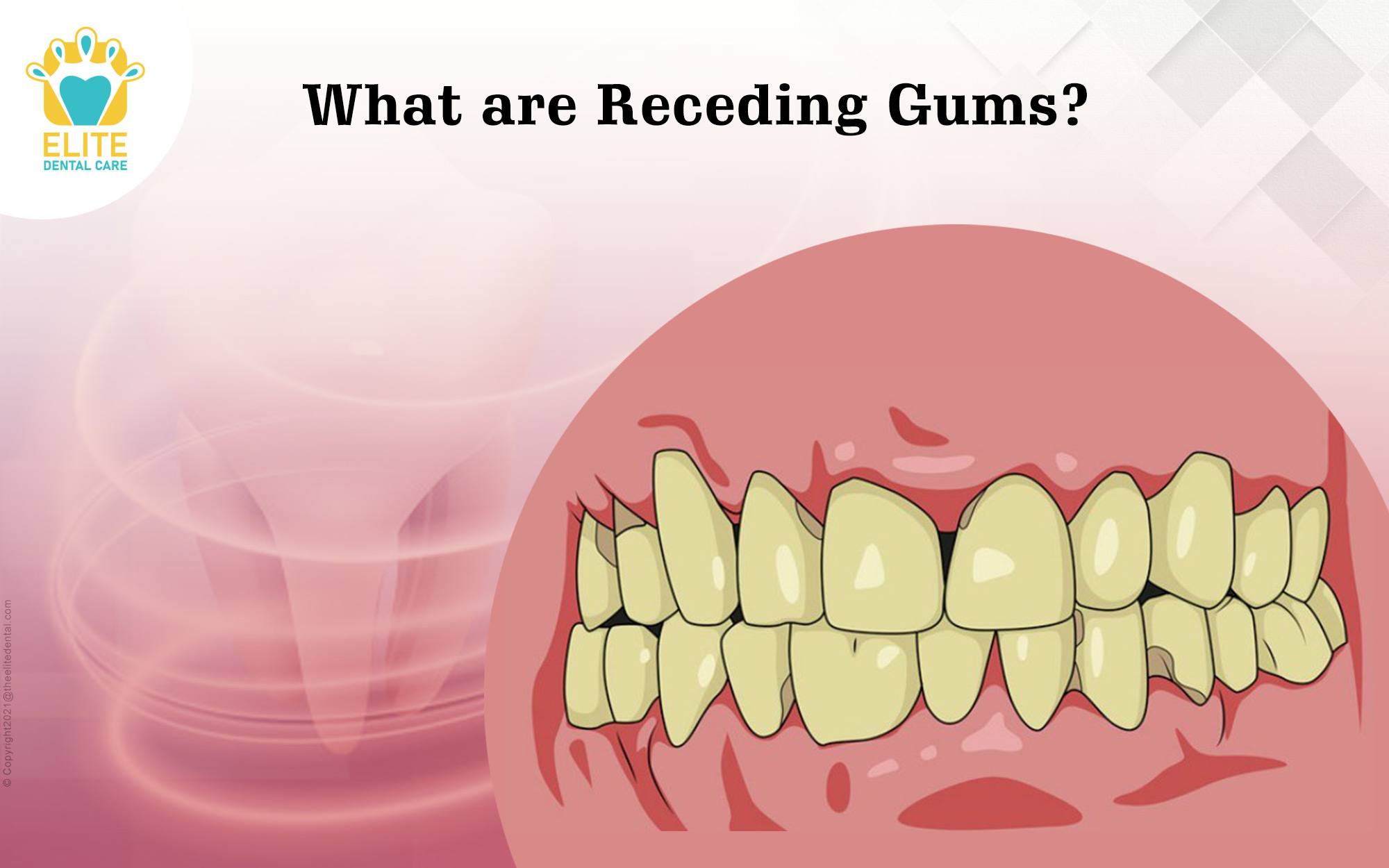 What are Receding Gums?