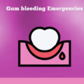 Gum Bleeding Emergencies