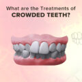 What are the Treatments for Crowded Teeth?