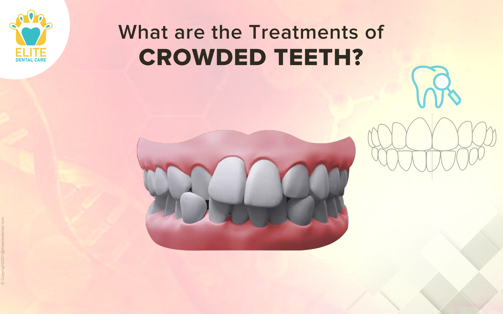 What are the Treatments for Crowded Teeth?