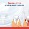 Periodontitis and its Symptoms