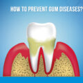 Stages of Gum Diseases