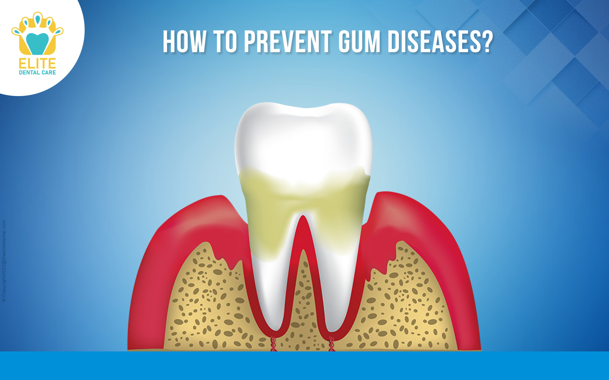 Stages of Gum Diseases