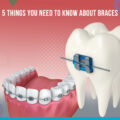 5 Things you need to know about braces