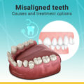 Misaligned Teeth – Causes and Treatment Options
