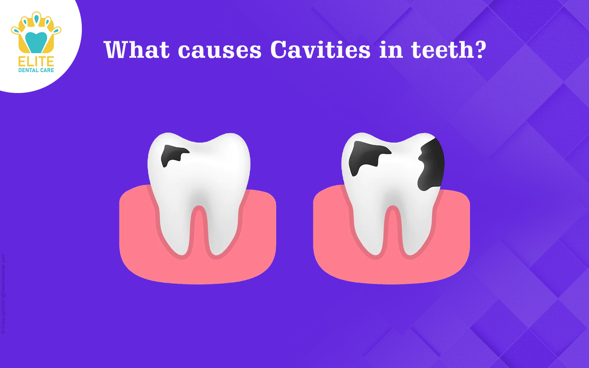 What Causes Caries in Teeth?