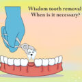 Wisdom Tooth Removal. When is it Necessary?