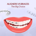 ALIGNERS VS BRACES – THE BIG CHOICE