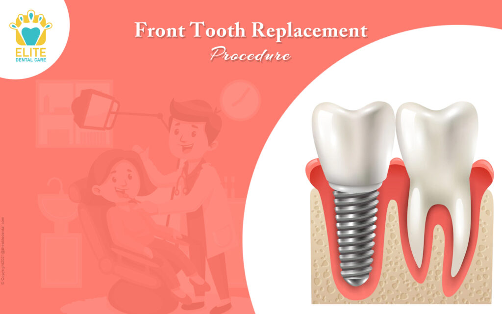temporary front tooth replacement options Archives Elite Dental Care