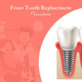 Front tooth Replacement Procedure