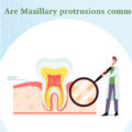 Are Maxillary Protrusions common?