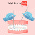 Adult Braces FAQs