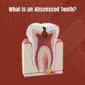 What is an Abscessed Tooth?