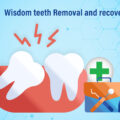 Wisdom teeth Removal and Recovery