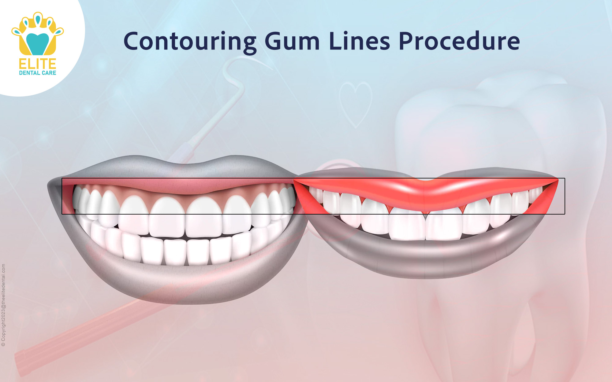 Contouring Gum Lines Procedure