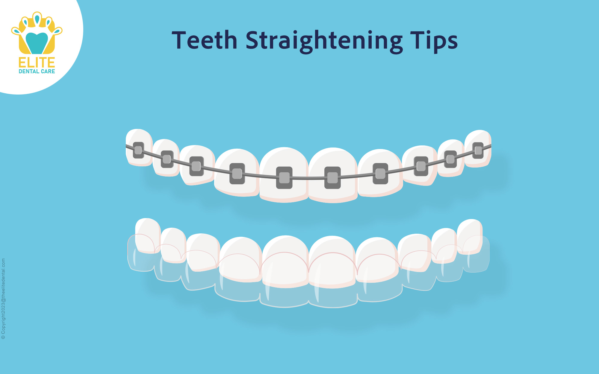 Teeth straightening tips