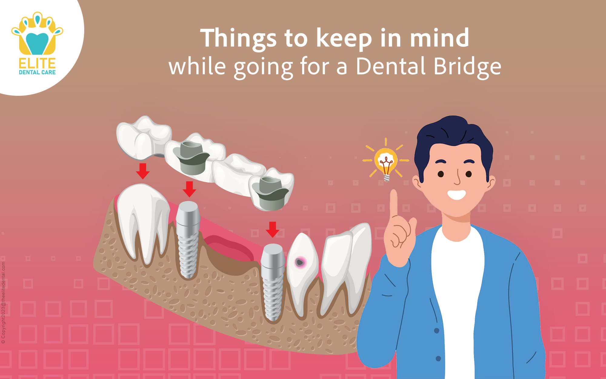 Things to keep in mind while going for a Dental Bridge