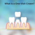 What is One-Visit Crown?