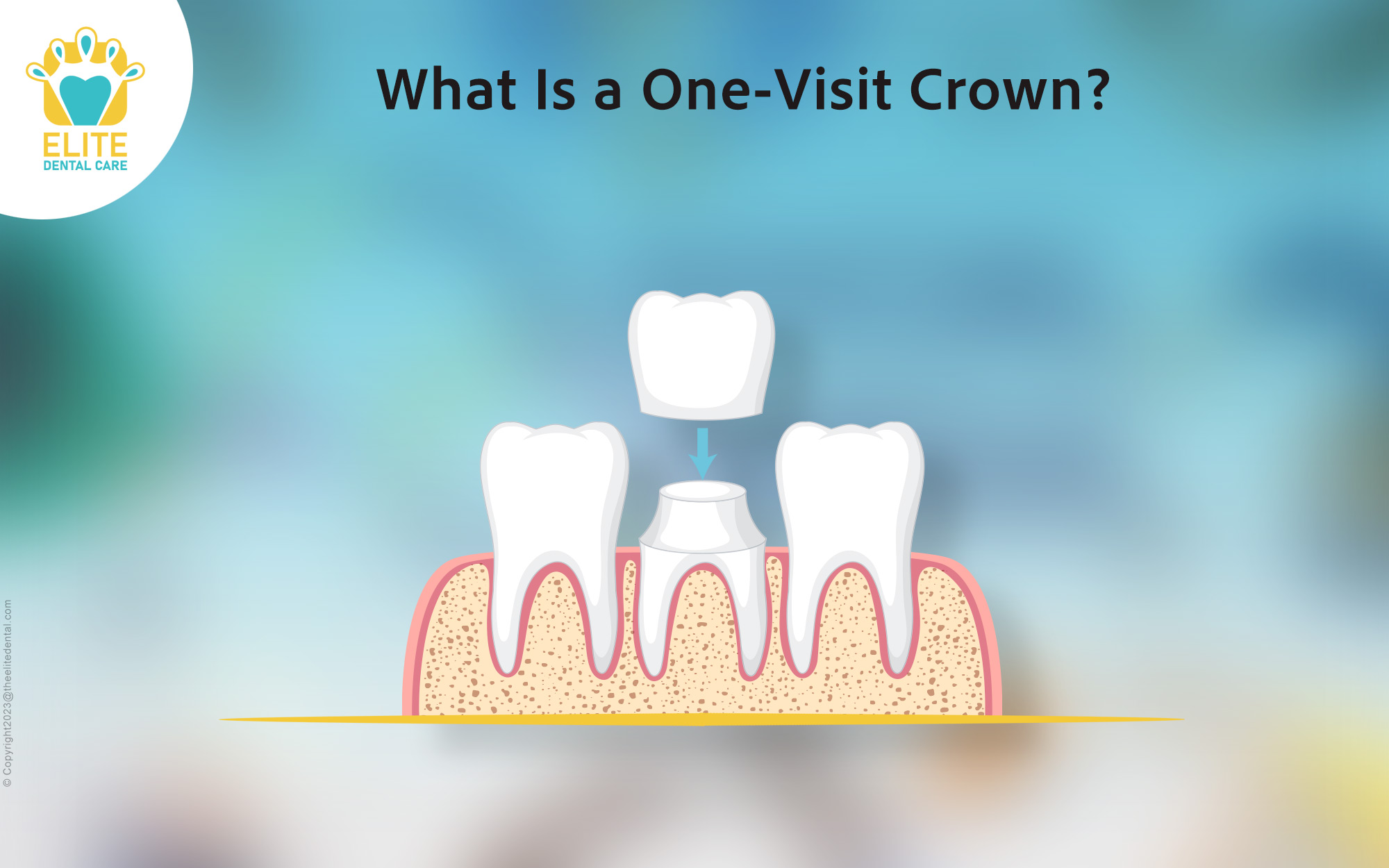 What is One-Visit Crown?