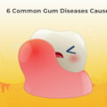 6 Common Gum Diseases Causes