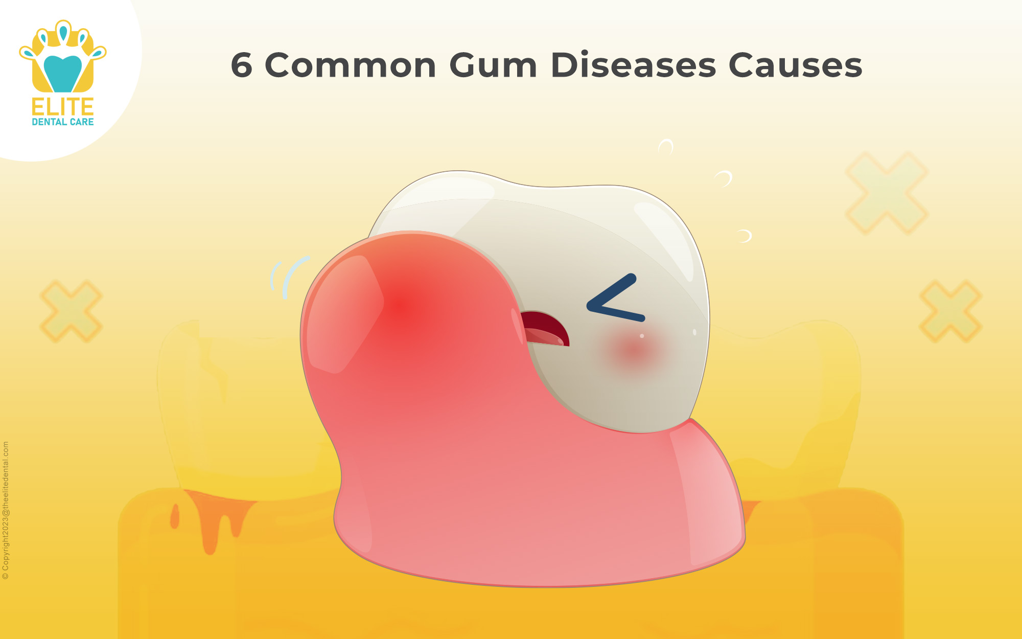 6 Common Gum Diseases Causes