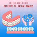 Before and after benefits of lingual braces